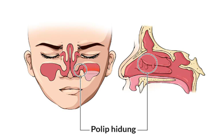 Mengenali polip hidung dan cara mengobatinya (ft/istimewa)