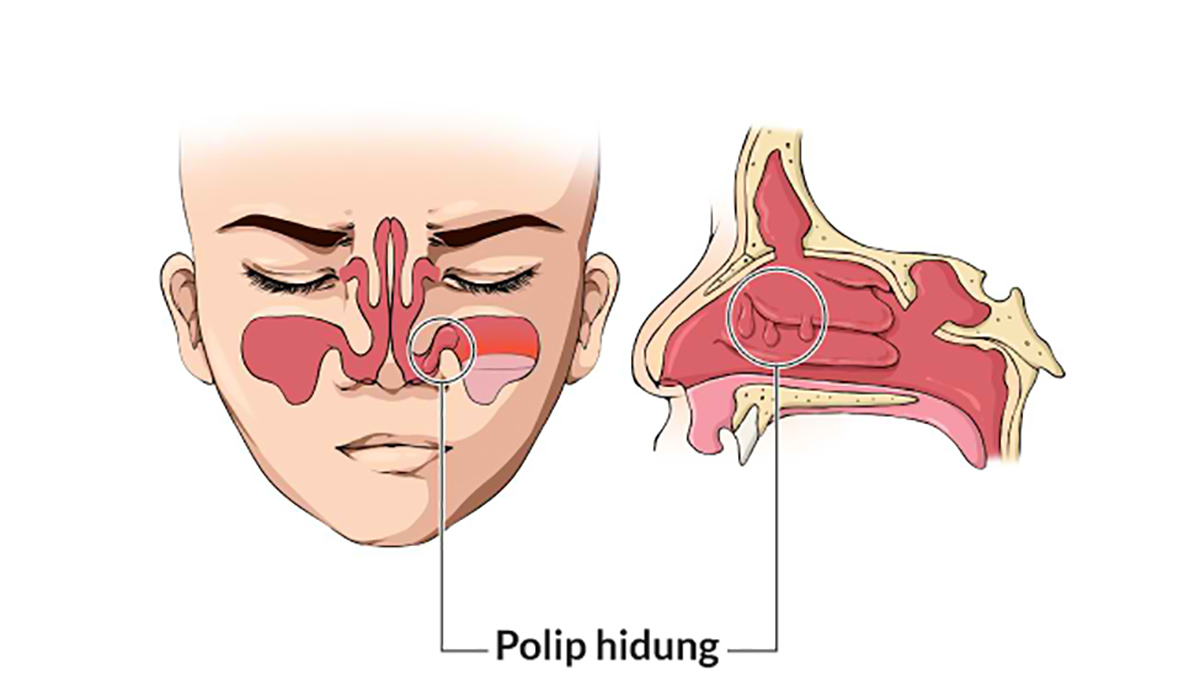 Mengenali polip hidung dan cara mengobatinya (ft/istimewa)