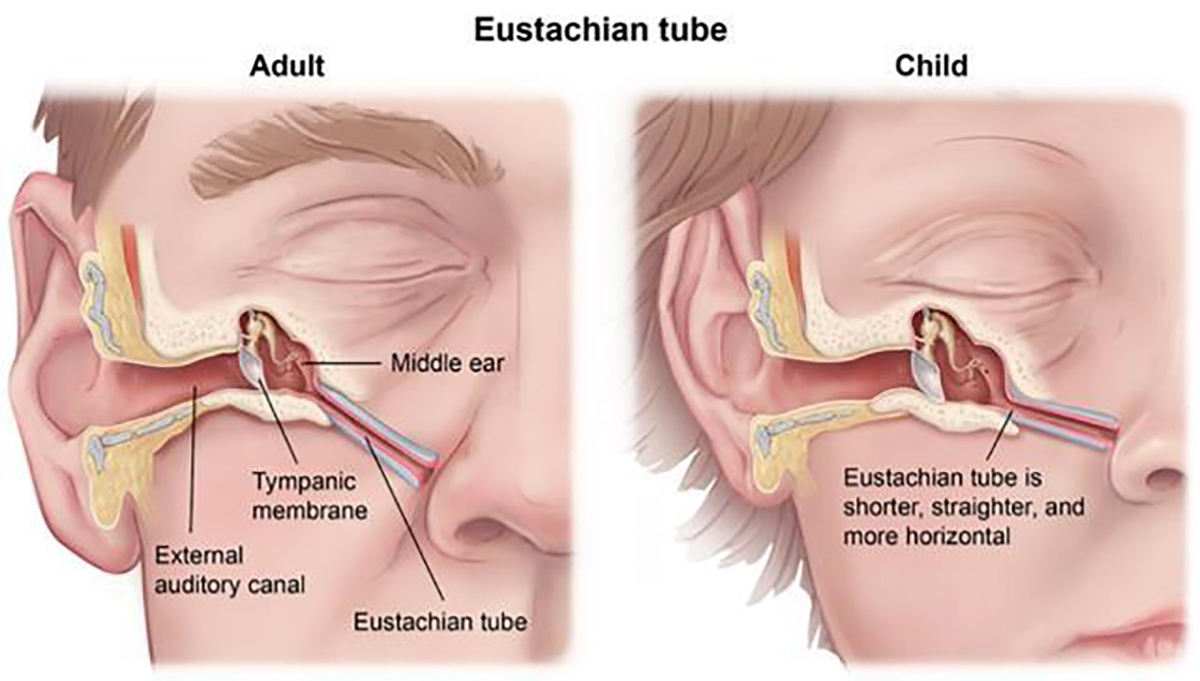 Perbedaan otitis media akut dan otitis media efusi (ft/istimewa)