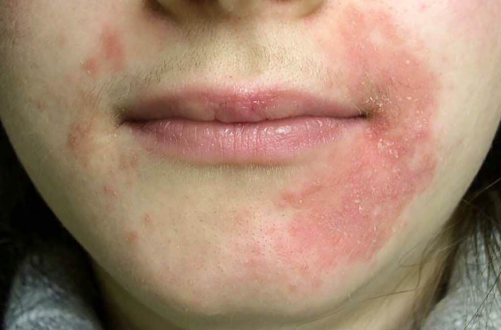 Pilihan Obat yang Efektif untuk Mengatasi Dermatitis pada Bibir: Panduan Pengobatan yang Tepat (ft/istimewa)