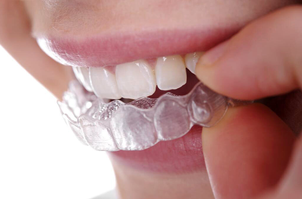 Retainer-Aligner-Invisalign, dan Behel: Memahami Perbedaan dan Keunggulan Masing-Masing (ft/istimewa)