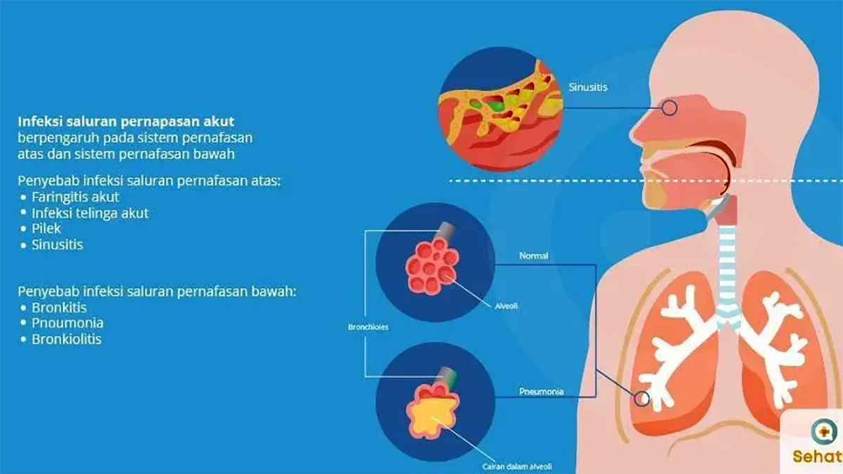 Infeksi Saluran Pernapasan: Penyebab, Gejala, dan Pengobatan Bronkitis (ft/istimewa)